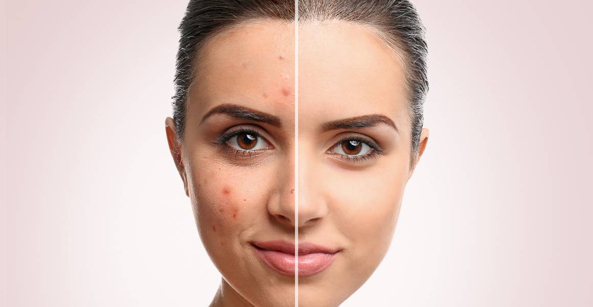 What is the Main Cause of Acne?