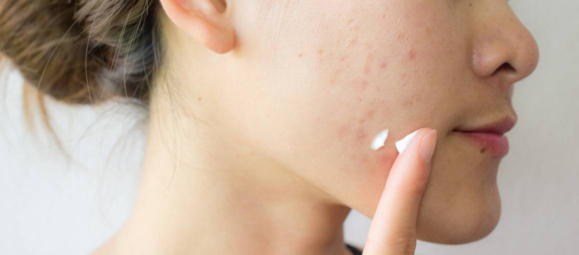 How can I prevent acne naturally?