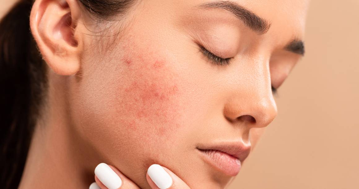 What Kills Acne Bacteria?