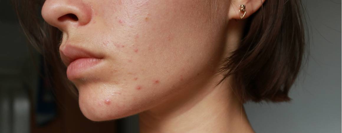 Does acne mean you have a weak immune system?