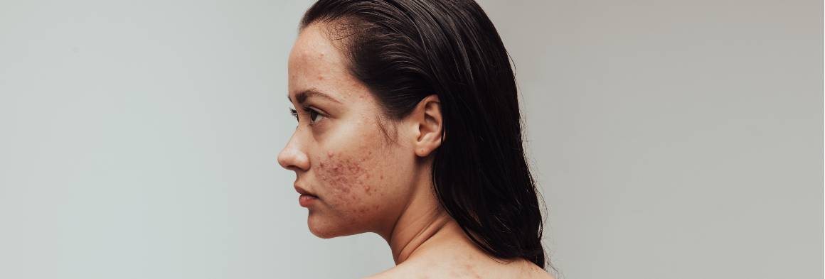 Can My Acne Go Away Naturally?