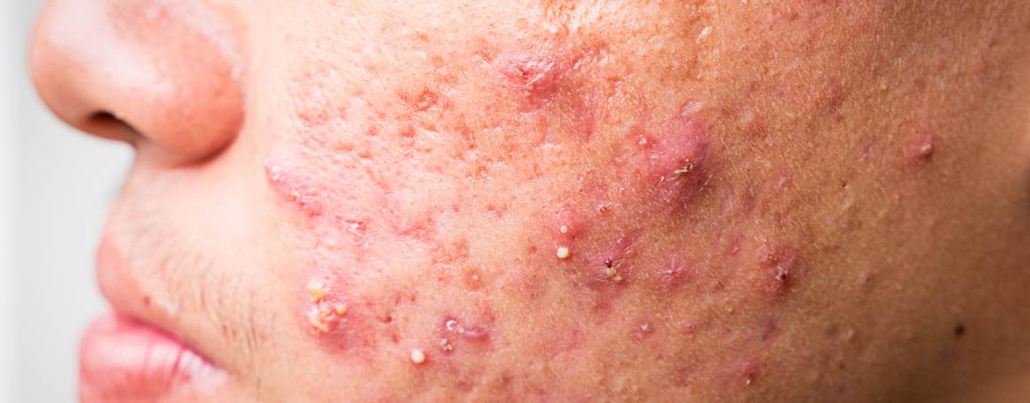 Does Acne Go Away On Its Own?