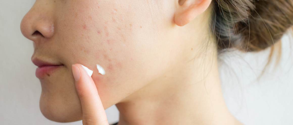 Should You Pop a Pimple?